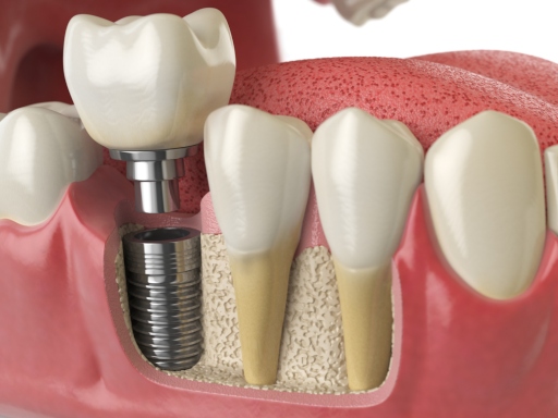 dental implant in human denture. 3d illustration
