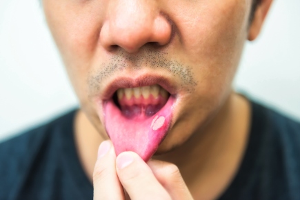 Inflammatory Bowel Diseases effect on Oral Health