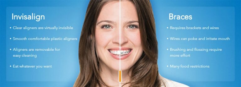 Invisalign-vs-braces - Invisalign Special Offer