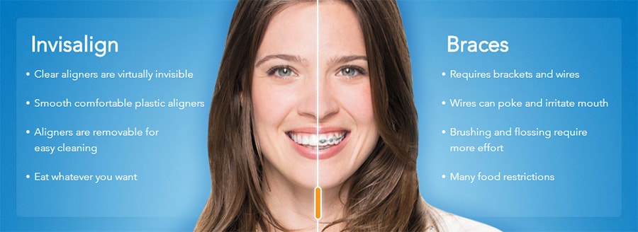 Invisalign-vs-braces - Invisalign Special Offer - Dentist Near Me, Bremerton dentist