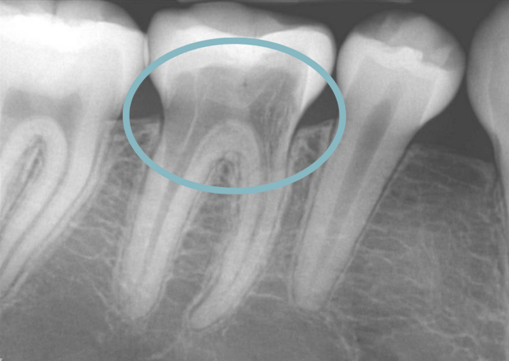 Root-Resorption