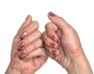 Psoriasis and oral health
